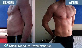 pectus excavatum surgery before and after