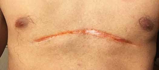 pectus excavatum surgery scar