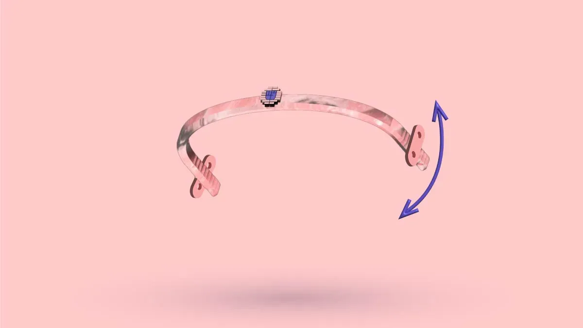 Bar Movement After Nuss Procedure: Should You Worry?