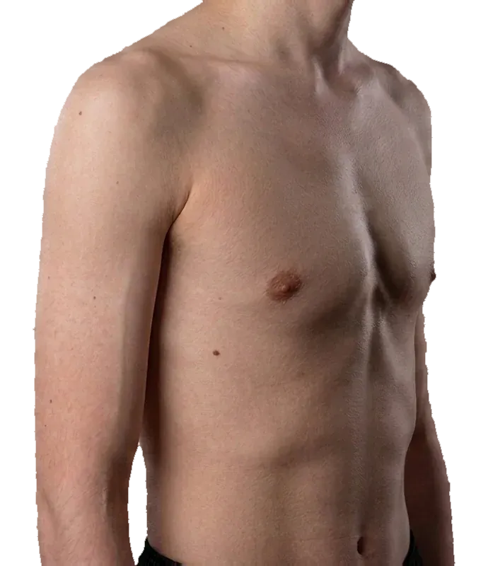 Pectus carinatum - a chest with the sternum and ribs pushed outward
