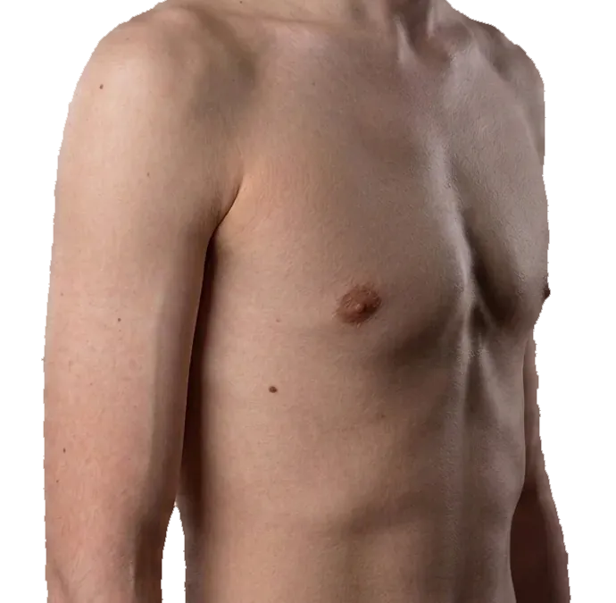 Pectus carinatum - a chest with the sternum and ribs pushed outward