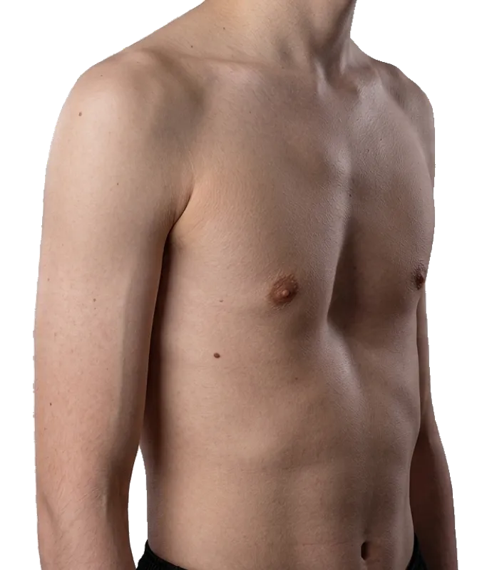 Pectus excavatum - a chest with the sternum sunken below the surrounding ribs