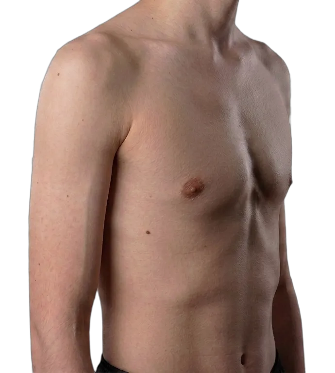 Pectus carinatum - a chest with the sternum and ribs pushed outward