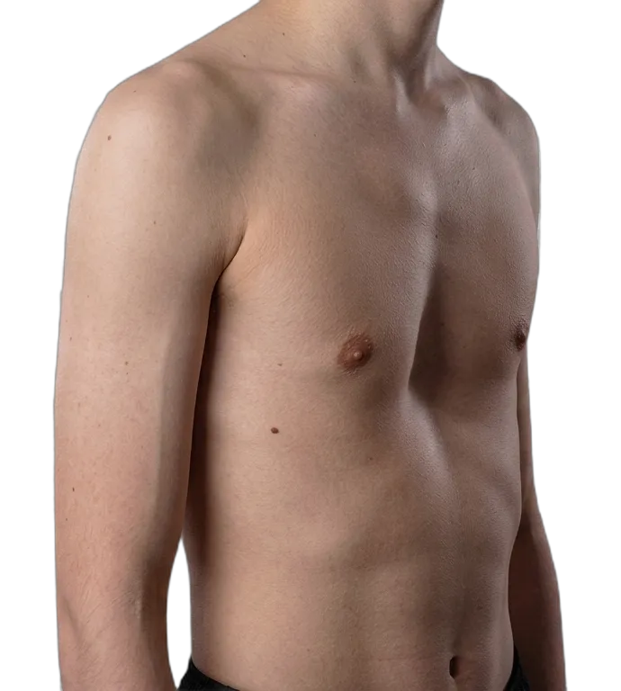 Pectus excavatum - a chest with the sternum sunken below the surrounding ribs
