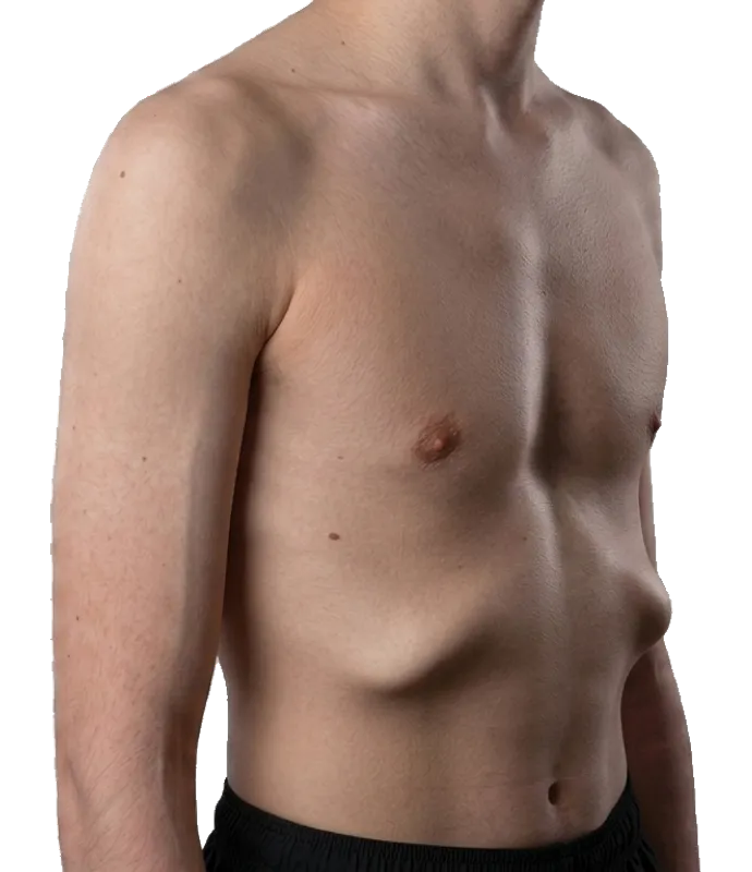 Rib flare - lower ribs angled outward and up instead of sitting flat