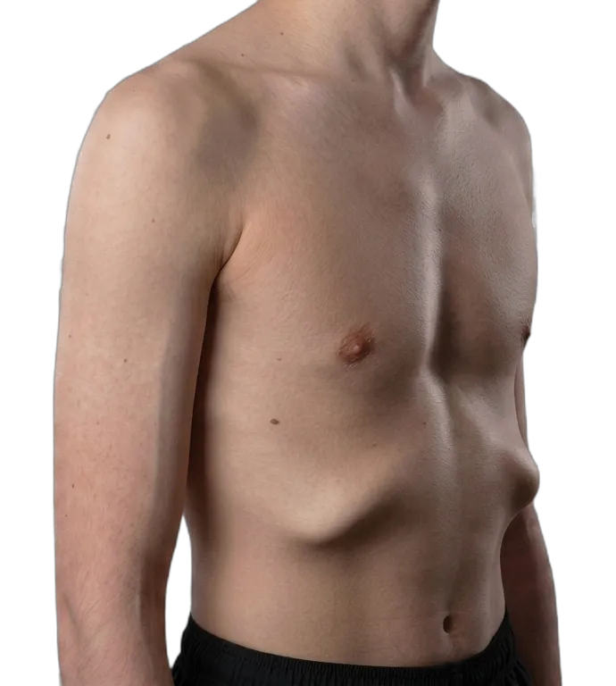Rib flare - lower ribs angled outward and up instead of sitting flat