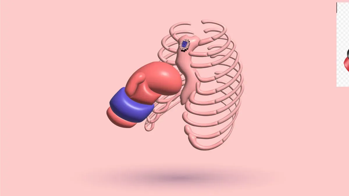 Pectus Excavatum And Contact Sports: Bar Displacement
