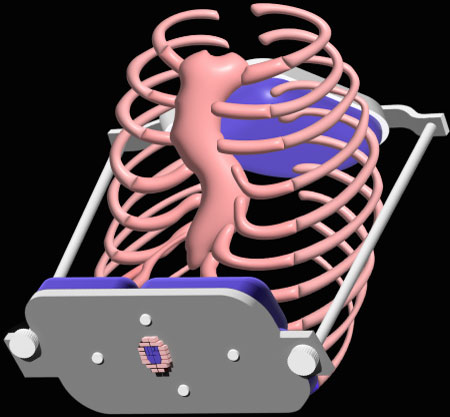 A rib cage held in a corrective brace
