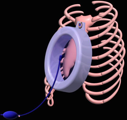 A vacuum bell applied to a rib cage