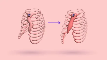 Pectus Excavatum And Overcorrection: How To Fix & More