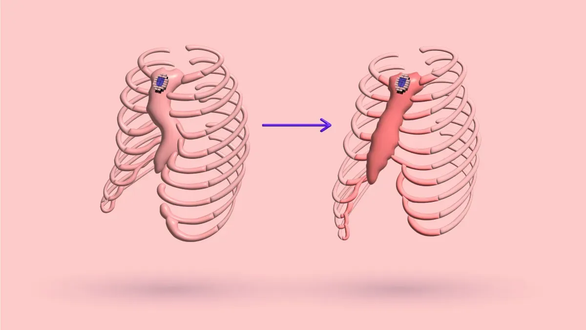 Pectus Excavatum And Overcorrection: How To Fix & More