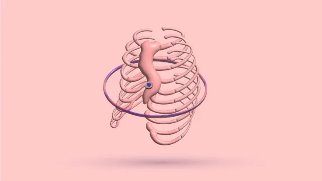 How To Prevent Pectus Excavatum Recurrence After Surgery