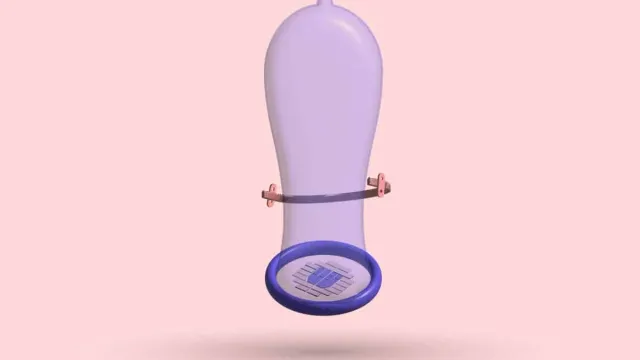 A 3D condom with a Nuss bar strapped around it