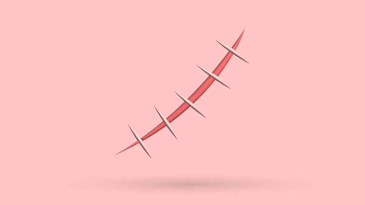 Pectus Excavatum Surgery Scar: 5 Tips To Heal Better