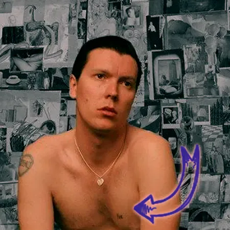 Alex cameron pectus excavatum deformity