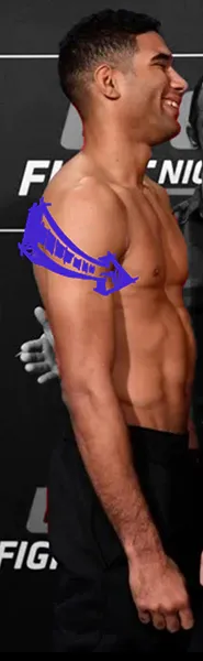 Hebert burns pectus excavatum concave chest abnormality
