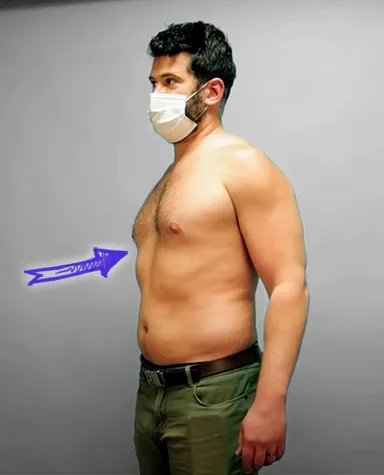 Steven crowder pectus excavatum chest before surgery