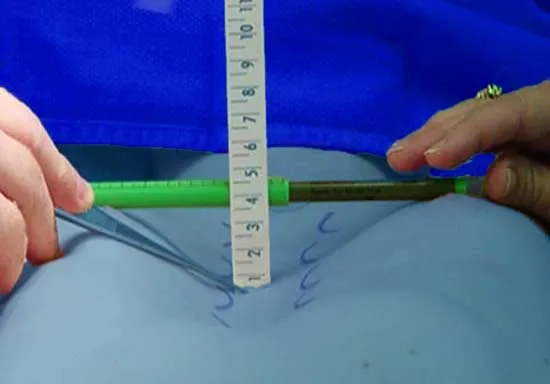 sunken chest measurement with ruler