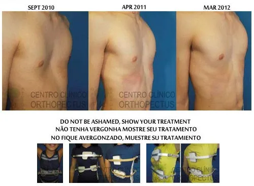 Dynamic remodeling before and after