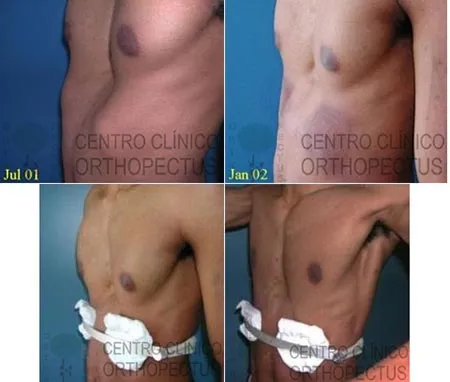 Orthopectus dr sydney haje transformation