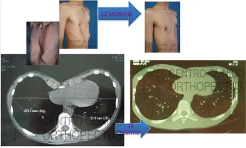 Orthopectus dynamic remodeling method transformation