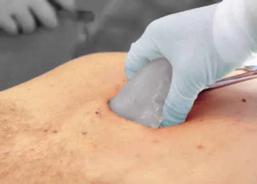 Plastic surgery to fix pectus excavatum
