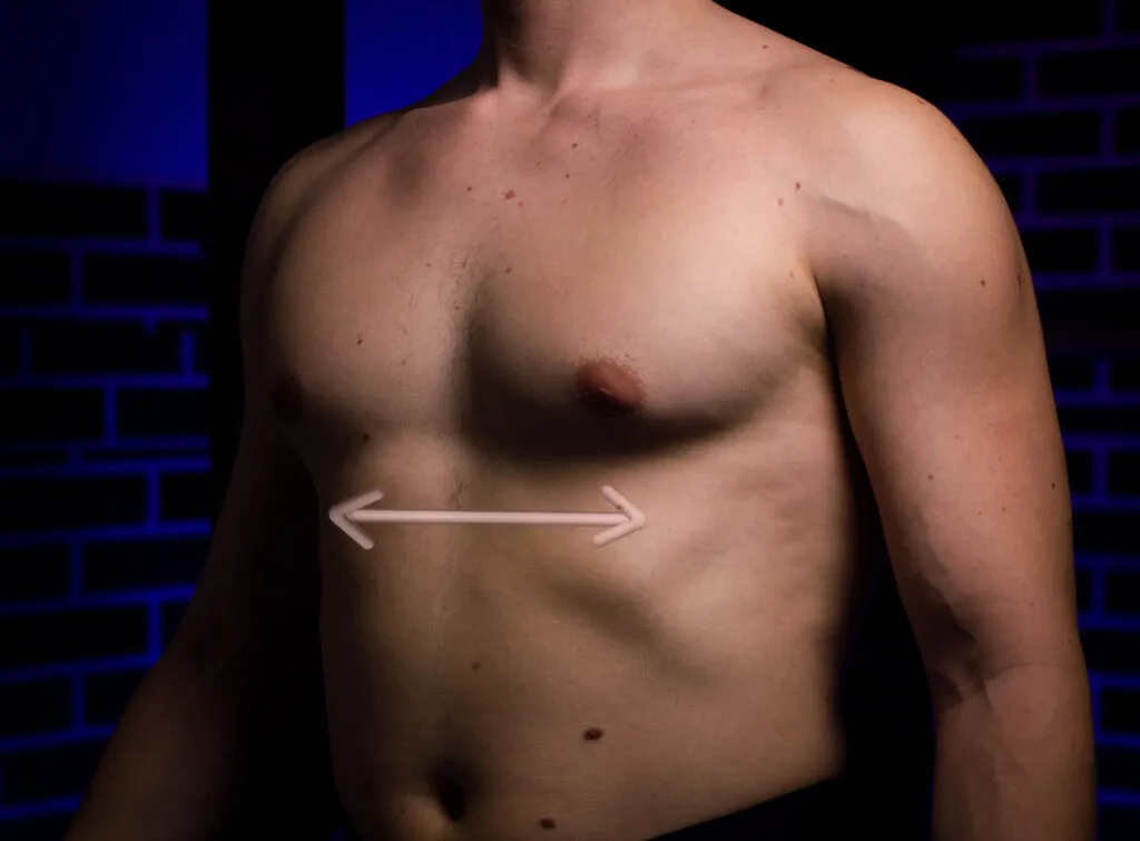 Wide but not deep pectus excavatum vacuum bell dimensions