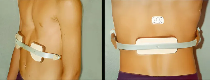 The rib flare brace adapted for pectus excavatum, targeting the lower flaring ribs instead of the sternum