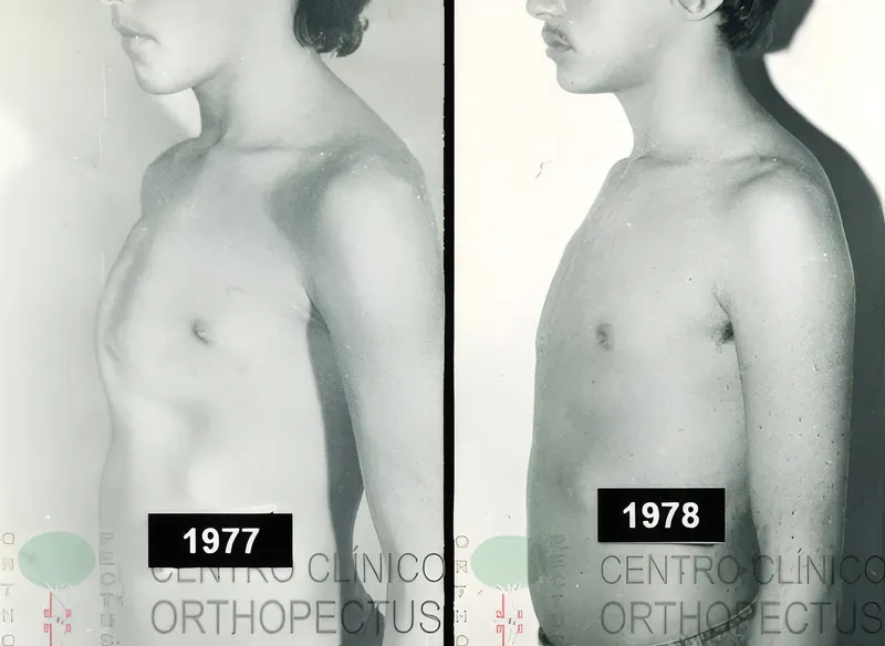 The first pectus carinatum patient treated with a custom compression brace