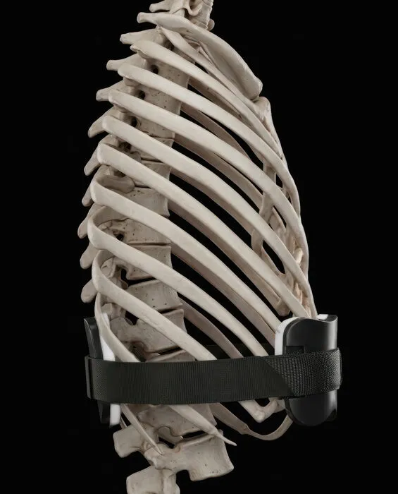 Skeleton side view showing the brace pushing the flared lower ribs back into position