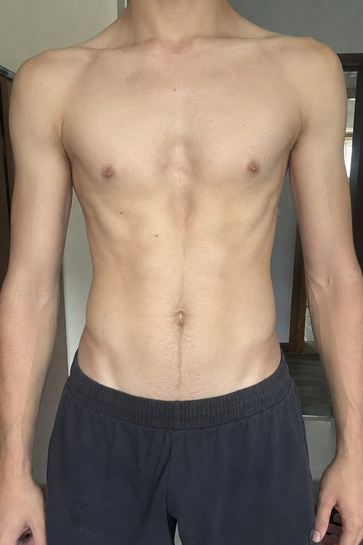 Andro — pectus excavatum chest before and after the protocol