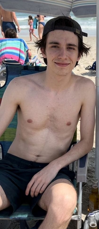 Ian — pectus excavatum and rib flare chest before and after the protocol