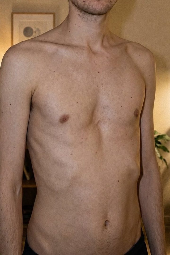 Lars — pectus excavatum and rib flare chest before and after 5 months of exercise and 1-on-1 coaching