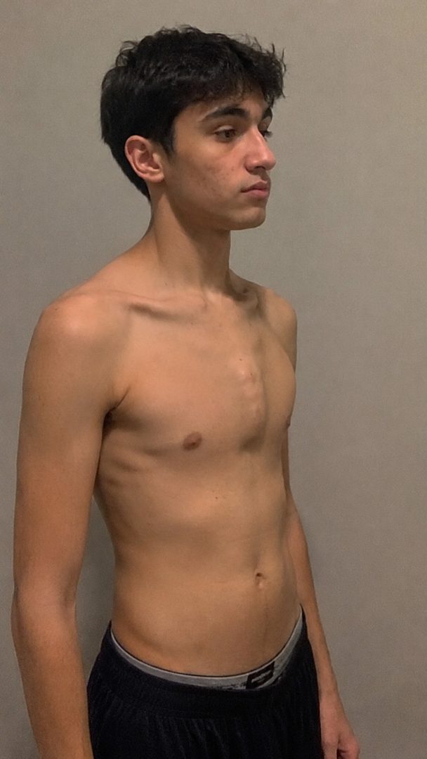 Omar Al Mansoori — pectus carinatum chest before and after 6 months of exercise and 1-on-1 coaching
