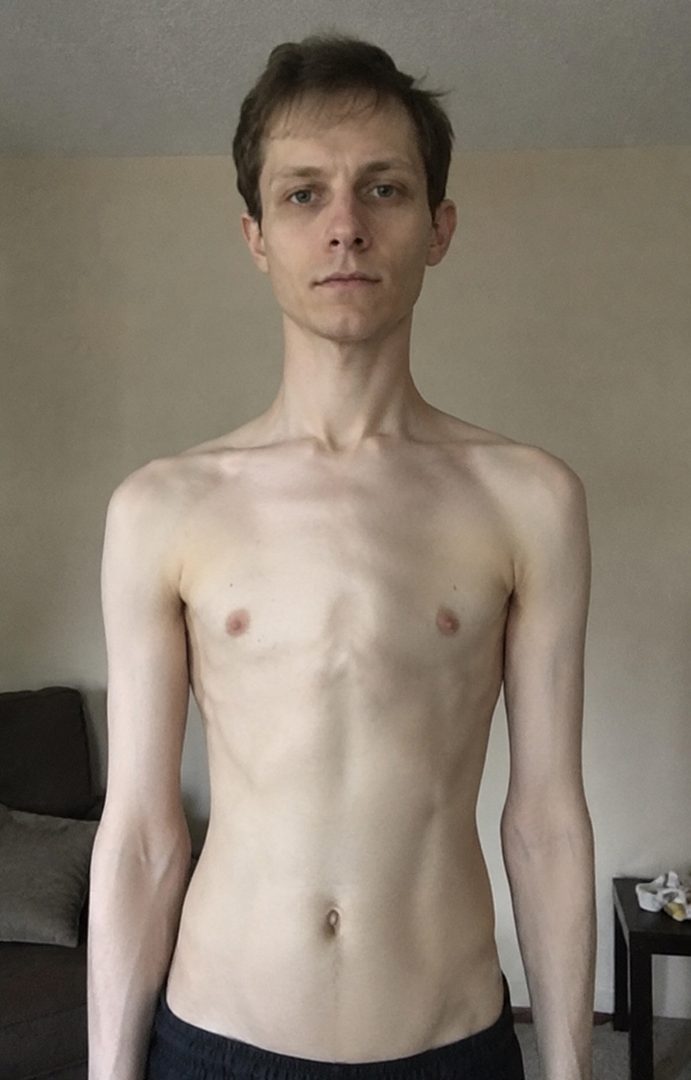 Taras Bondarenko — pectus carinatum chest before and after exercise and 1-on-1 coaching