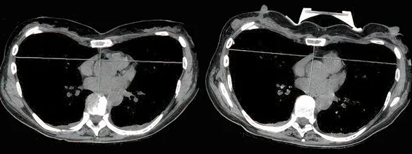 Patient 5, CT scan of pectus excavatum lifted by the vacuum bell