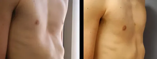 Patient 9, before and after evidence of vacuum bell success