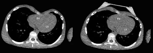 Patient 6, CT scan of the chest after successful vacuum bell use