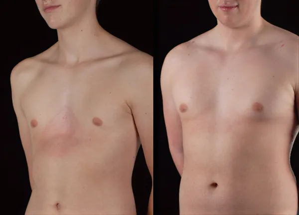 Patient 6, chest before and after a course of vacuum bell sessions