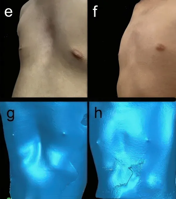 Patient 2, before and after vacuum bell correction shown on a 3D chest scan