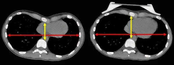 Patient 1, CT scan showing the sternum before and during vacuum bell use