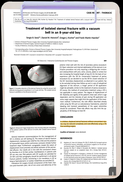 Treatment of isolated sternal fracture with a vacuum bell in an 8-year-old boy