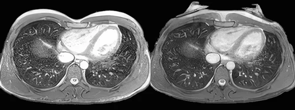Patient 2, CT scan confirming sternal elevation after vacuum bell use
