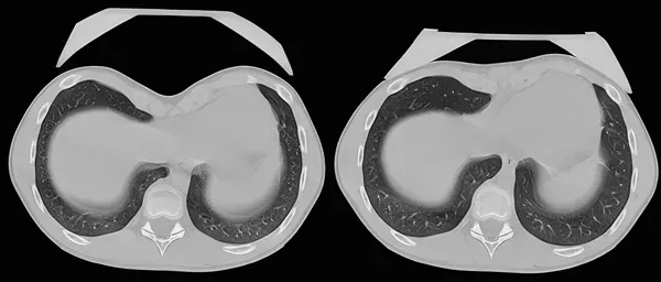 Patient 3, before and after CT comparison of vacuum bell correction