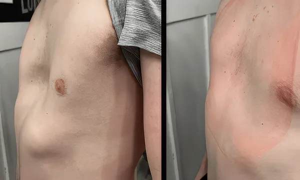 Patient 8, chest elevation showing vacuum bell effectiveness
