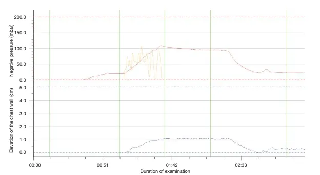 Graph showing chest elevation within 2 minutes 33 seconds and 6 pumps of the hand pump