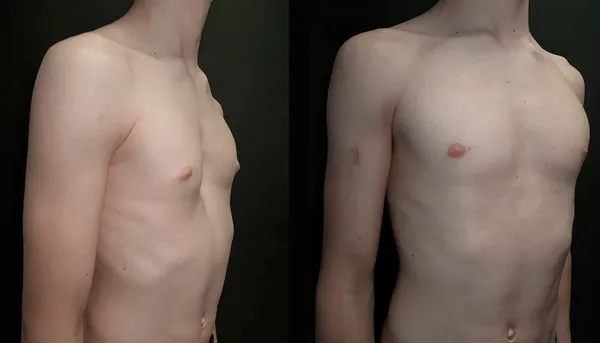 Patient 3, non-surgical chest correction results after vacuum bell use