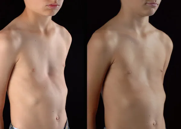 Patient 5, young boy with a sunken chest corrected with the vacuum bell