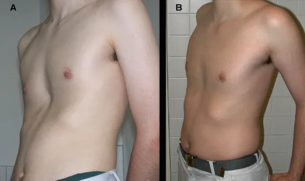 Patient 7, vacuum bell success story, before and after photos