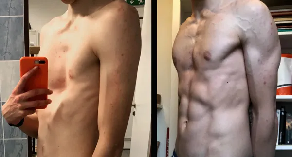 Patient 10, pectus excavatum improvement after vacuum bell therapy